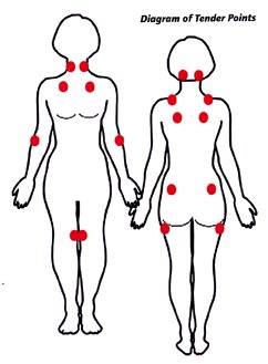 fibromyalgie